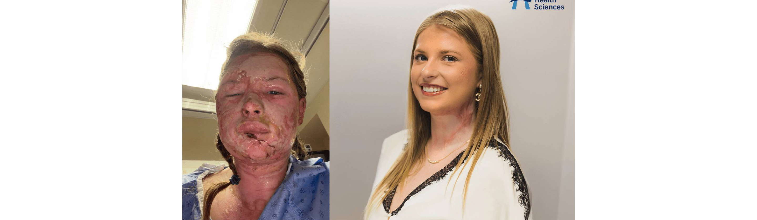 A picture of a woman with severe burns on the left and a picture of her recovered face on the right